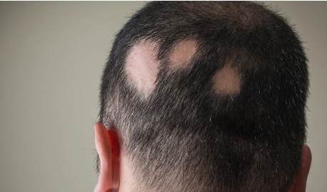 Alopecia Alopecia