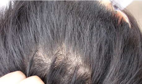 Dandruff Dandruff removal treatment