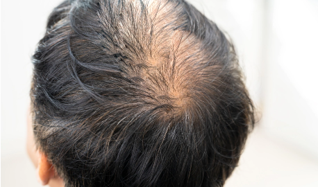 Hair Loss Hair loss Treatment