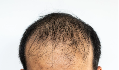 Hair Thinning Hair thining