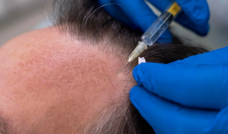 Hair transplant 1 Hair Transplant