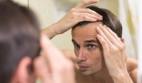 pattern baldness PatternBaldness