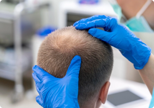 best hair transplant clinic in Chennai