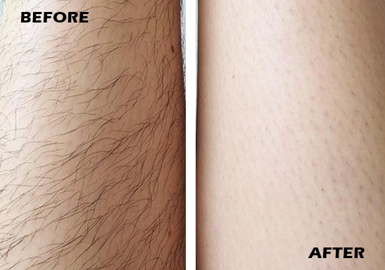 Laser Hair Removal treatment in Chennai