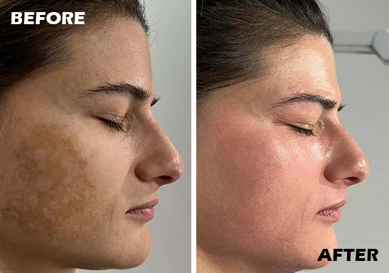 melasma skin treatment